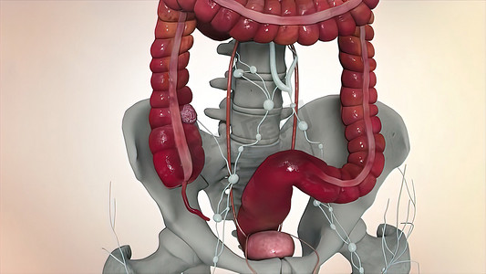 可见摄影照片_结肠镜检查期间可见肠道或肠癌肿瘤。