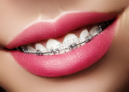 美丽洁白的牙齿，戴着牙套。