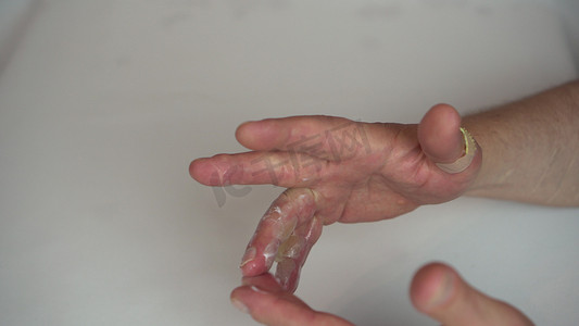 一名男子在二度热水烫伤的手上涂抹了药膏。