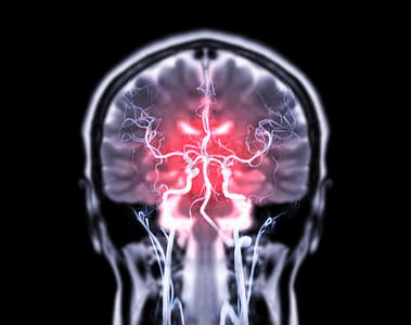 冠状面视图中的 MRI 脑部冠状 T2W 和 MRA 脑部融合。
