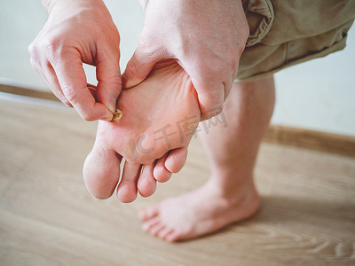 男人脚上跖疣的特写照片。