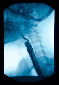图方摄影照片_上消化道 (UGI)、食管 X 射线图像。