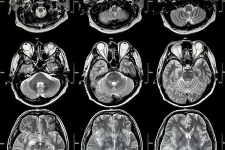 脑部 MRI（脑部横截面）（医学、保健、科学背景）