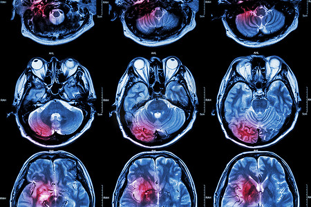 脑中风种类摄影照片_脑部胶片MRI（磁共振成像）（中风、脑肿瘤、脑梗塞、脑出血）（医疗、保健、科学背景）（脑部横截面）