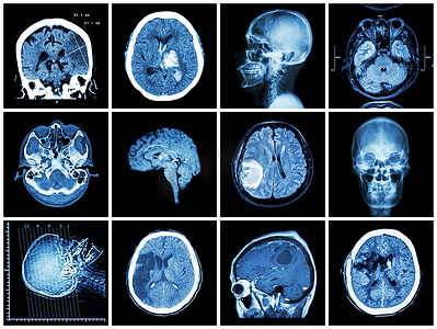 收集摄影照片_脑部疾病收集（脑部CT扫描和MRI：显示脑梗塞、脑出血、脑肿瘤、基底节出血（开颅术后状态））（保健概念）
