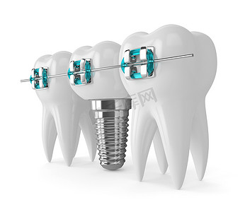 牙齿植入摄影照片_3d. 牙种植体和支架的牙齿呈现