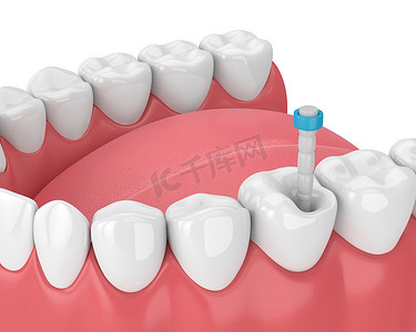 3d 渲染下巴与牙齿和纤维岗位在白色。牙髓治疗概念