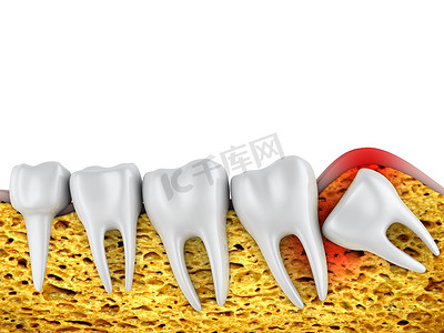 牙科排磨牙和不正确定位智齿。3d 渲染.