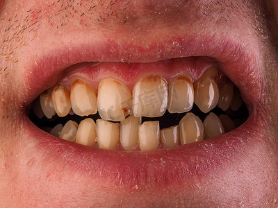 牙科医学和保健-人类患者张开嘴显示蛀牙蛀牙。不健康的假牙、额牙上的牙垢、牙菌斑和牙龈炎.