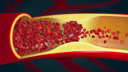 狭窄血管中的血凝块引起的栓塞- 3D例