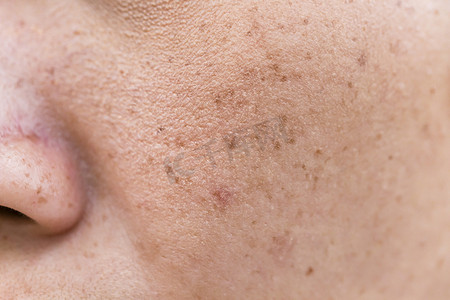 皮肤切换摄影照片_亚洲女人脸上的雀斑、皮肤问题