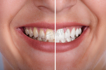 口腔矫正前后摄影照片_美白前后微笑女性牙齿特写