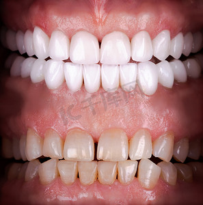 氧化锆拱形陶瓷假体植入冠冕前、后的完美笑容。牙科康复治疗诊所的病人。口腔外科手术美白牙的结果