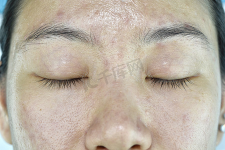 面部皮肤问题, 成人老化问题, 皱纹, 痤疮疤痕, 大毛孔, 黑斑, 脱水皮肤.