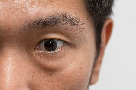 亚洲男性男子面部油性皮肤大眼包左眼