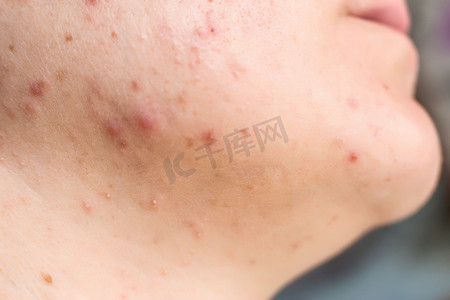 红粉刺和一个女孩脸上和脖子上的皮疹，巨怪，荷尔蒙