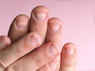 肝脏造成负担摄影照片_男性指甲上的白斑是由缺乏钙、锌或家庭化学品在粉色背景下造成的。这种病叫做白血病.