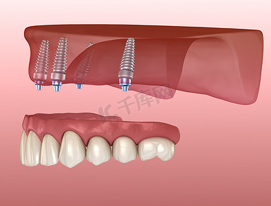 上颌骨假体，牙龈全长在4个系统上，植入物支持。医学上准确的人类牙齿和假牙3D图像