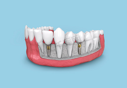 下颌3d 的牙种植模型图解