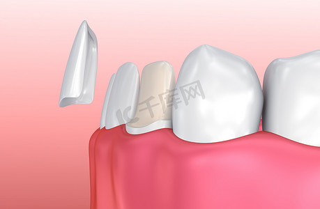 牙科贴面: 瓷贴面安装程序。3d 插图