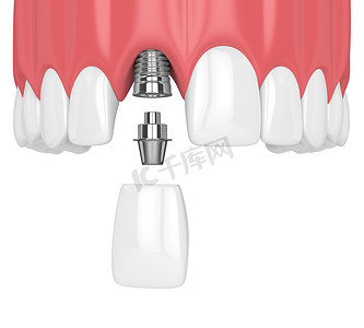 3d. 在白色背景下用牙齿和门牙植入上颌下颌