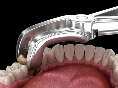 龋伤磨牙的拔牙.医学上准确的牙齿3D图像.