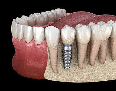 前磨牙修复植入物。医学上准确的人类牙齿和假牙概念三维图像