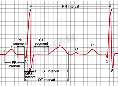 与标记 Qrs 复合波的心电图图表