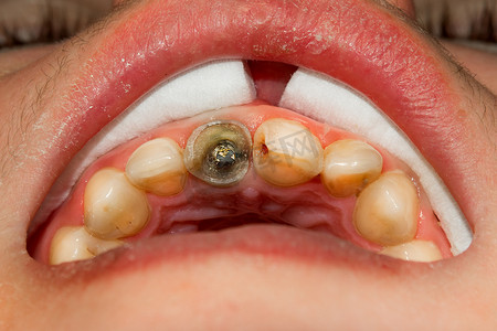 特写治疗人牙在牙填装腐烂的诊所。Ochistka 和运河用橡胶坝密封系统和分期
