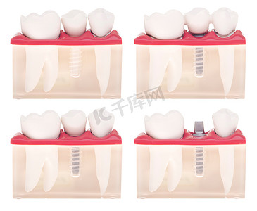 种植牙模型