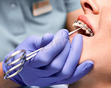 牙科摄影照片_牙科医生用手把弹性橡皮筋贴在病人的支架上.牙齿上有金属丝支撑的妇女正在接受牙齿矫正治疗。口腔学、牙科学和正畸学的概念.
