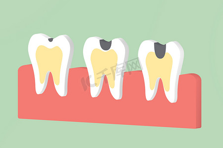牙齿蛀牙摄影照片_一步蛀牙牙齿-牙科卡通3d 渲染平面风格设计的可爱字符