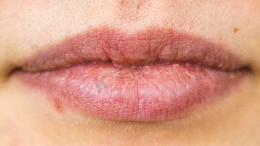 女性干唇带疱疹冷痛感