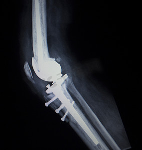 X 线骨科扫描的膝关节半月板植入修复术