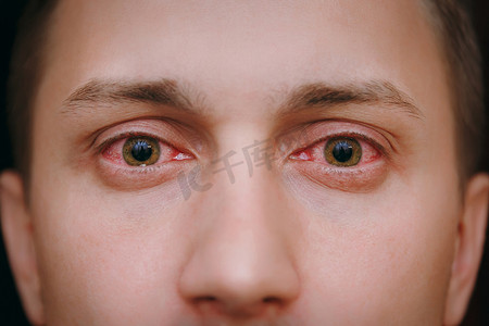 一名受结膜炎影响的男子两眼恼怒的红血球特写