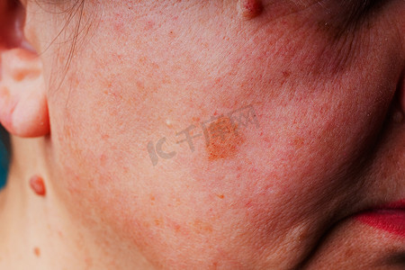 Age spots, moles and freckles on the face close-up. Spots on the skin of the face. Texture of middle-aged female skin