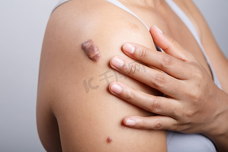瘢痕疙瘩摄影照片_在人体皮肤上的疤痕