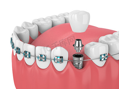 植入物摄影照片_3d. 用正畸牙套和牙科植入物进行牙齿渲染。正畸大括号概念