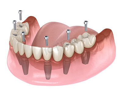 下颌骨假体全部在4个系统上，由植入物支撑，螺钉固定。牙科概念的医学上准确的3D图像