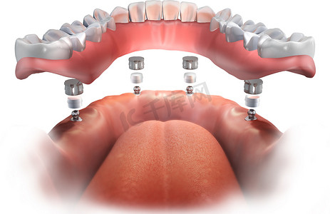 下种植支持全口义齿。 全部在4个植入物上 球附件上层建筑。 3d说明.