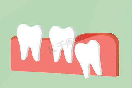 智齿 (角或内侧嵌塞) 与炎症对其他牙齿的影响-牙科卡通3d 渲染平面风格设计的可爱字符
