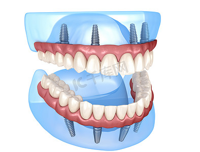 上颌骨和下颌骨假体均在4个系统上，由植入物支持。医学上准确的人类牙齿和假牙3D图像