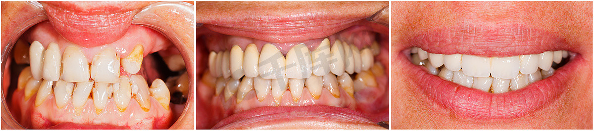 之前和之后摄影照片_治疗前后的牙齿