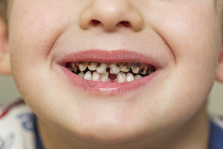 小孩张嘴,蛀牙.牙齿保健.