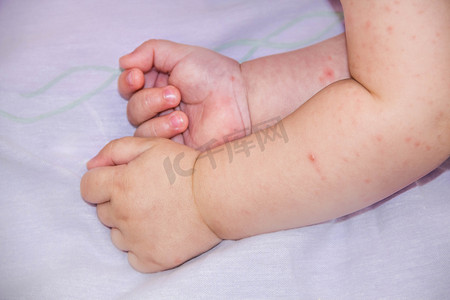 皮疹皮炎问题的婴儿。患有食物过敏的过敏。特写特应性皮肤脸颊上的症状。概念