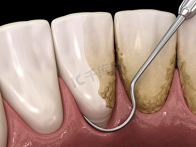 口腔摄影照片_口腔卫生：烫伤和根部修整（常规牙周病治疗） 。医学上准确的人类牙齿治疗三维图像