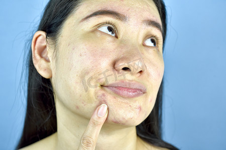 亚洲女性手指点在白头痤疮在下巴上, 成人担心面部皮肤问题, 皱纹, 大毛孔, 干燥皮肤, 痤疮疤痕, 皮肤老化的迹象.