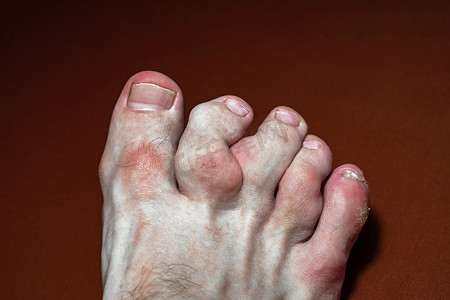 多嘴的脚趾。受痛风影响的脚趾-尿酸代谢紊乱的一种疾病。类风湿关节炎步行。有红肿斑的趾瓣畸形，有选择的焦点