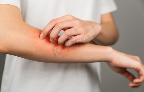 年轻女子手臂上有一个红斑，是由于昆虫叮咬或化学过敏反应引起的瘙痒引起的