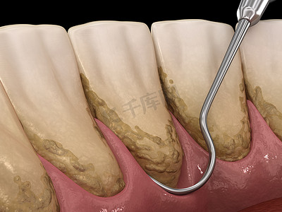 口腔卫生：烫伤和根部修整（常规牙周病治疗） 。医学上准确的人类牙齿治疗三维图像
